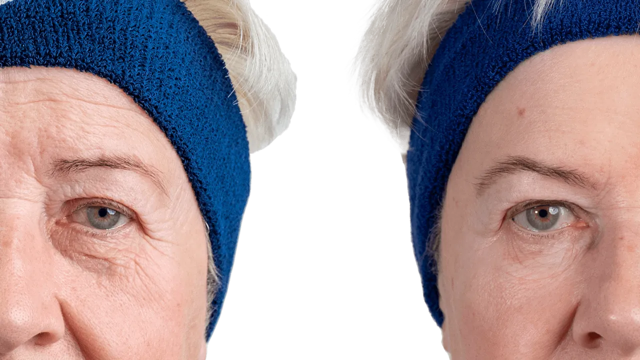 Lekarz medycyny estetycznej wyjaśniający r&oacute;żnice między toksynami botulinowymi