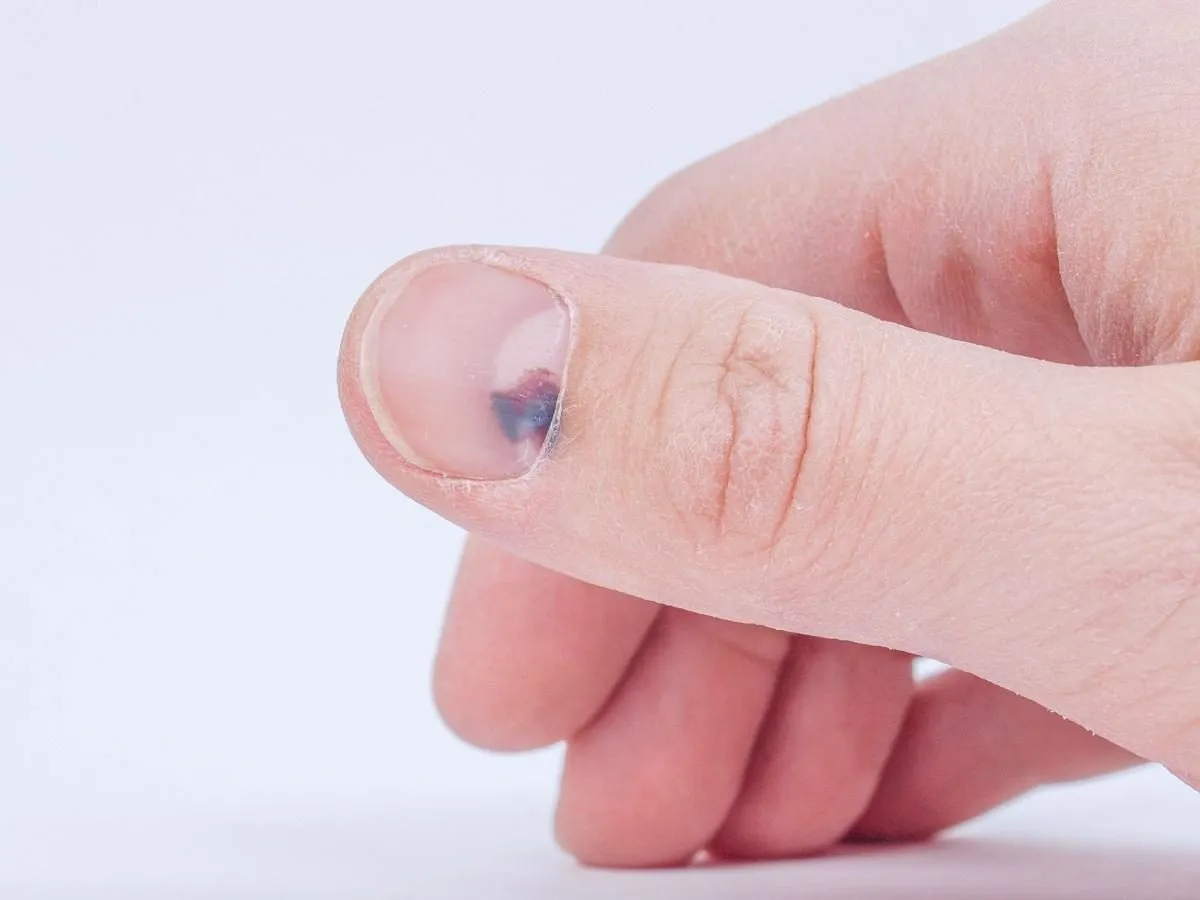 objaw Hutchinsona czerniak paznokcia