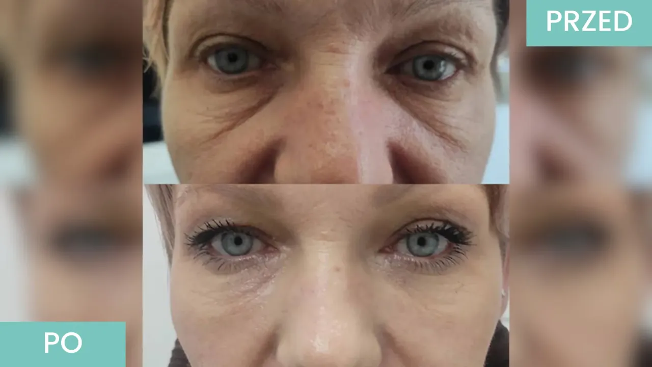 Por&oacute;wnanie efekt&oacute;w botoksu i kwasu hialuronowego przed i po