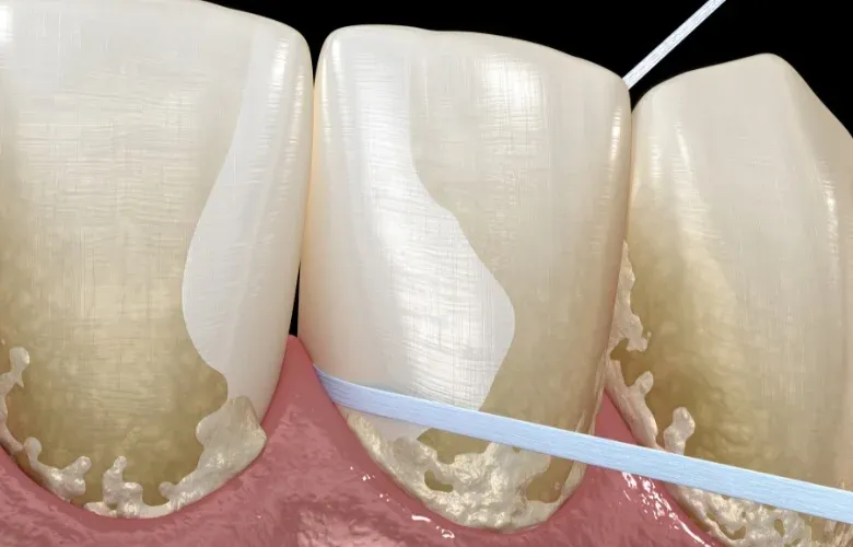 Płytka bakteryjna na zębach i kamień nazębny