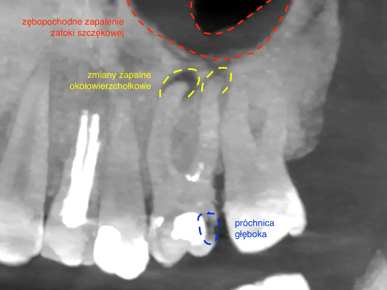diagnostyka endodontyczna RTG CBCT mikroskop