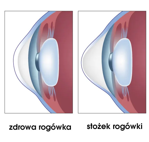 stożek rog&oacute;wki objawy por&oacute;wnanie