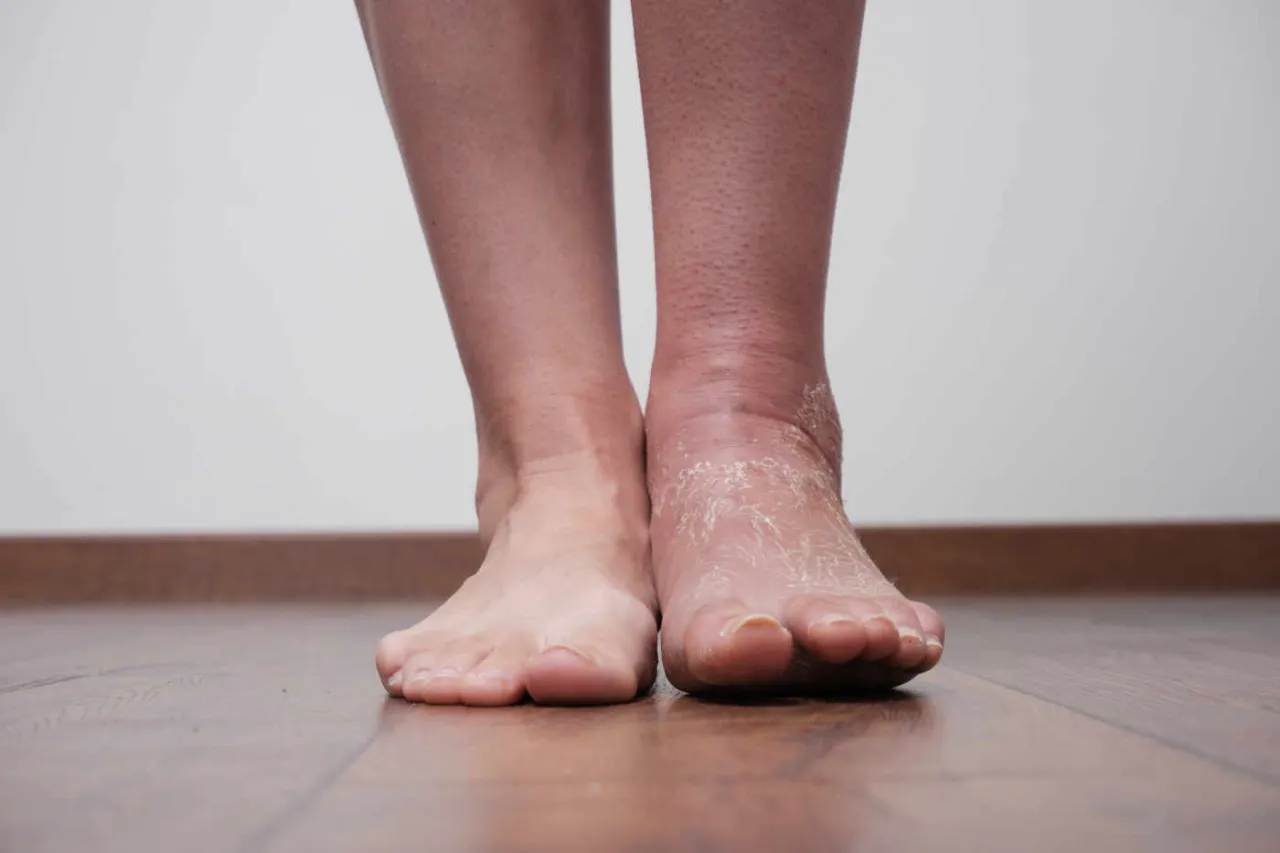 pierwsza pomoc skręcona kostka