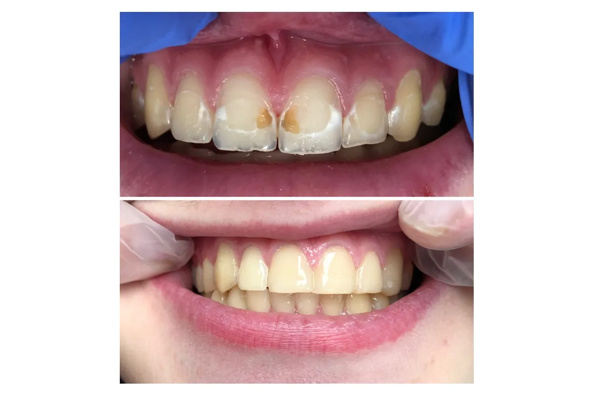 prawidłowe szczotkowanie zębów i dziąseł