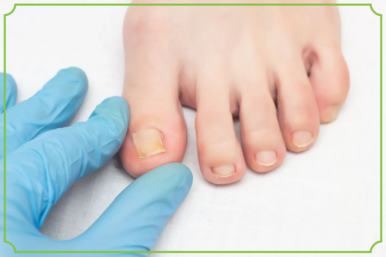 olejki eteryczne na grzybicę paznokci