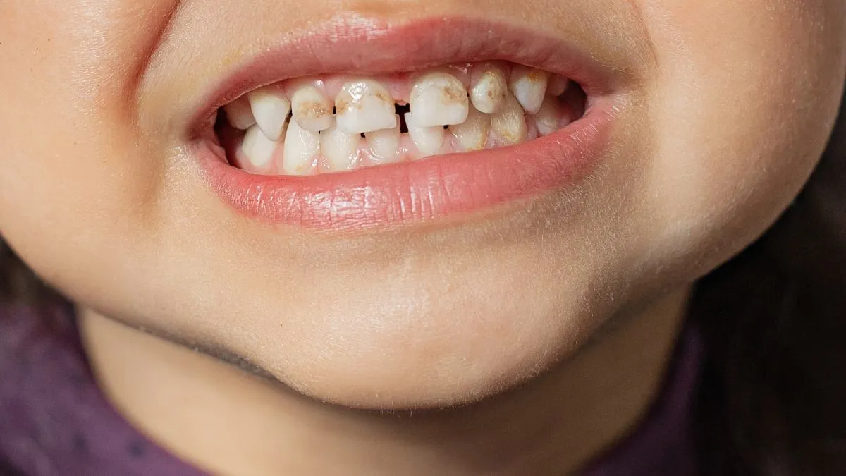 dziecko z przebarwieniami na zębach po antybiotyku