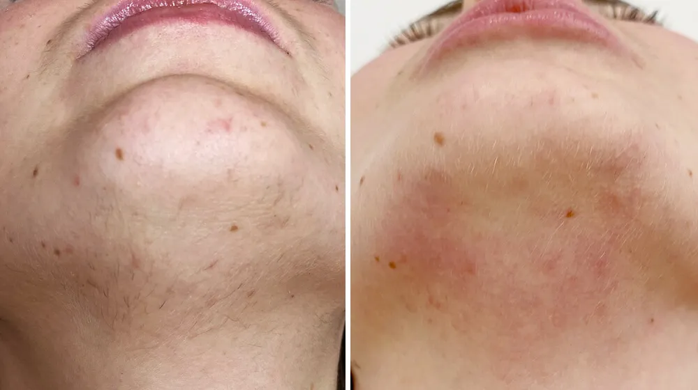 skóra po depilacji laserowej przed i po