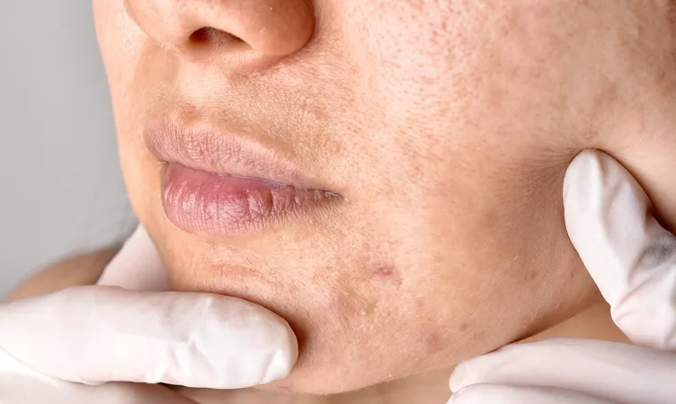 dermatolog gabinet leczenie trądziku