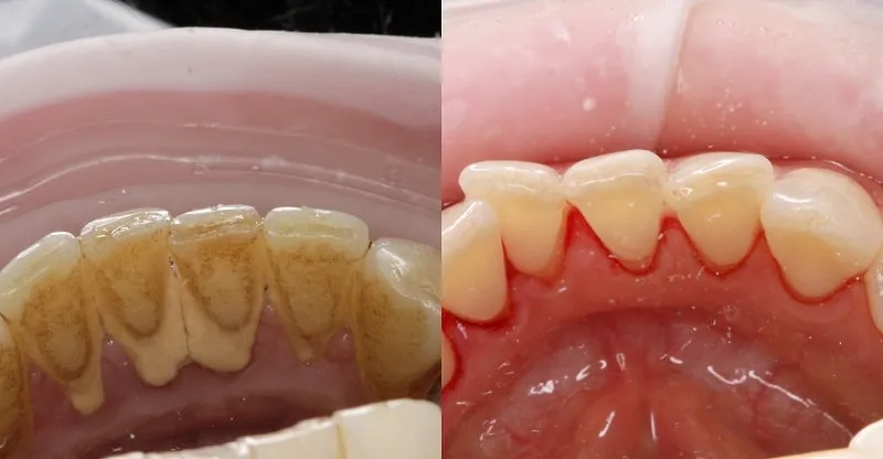 Zabiegi periodontologiczne, skaling i piaskowanie zębów