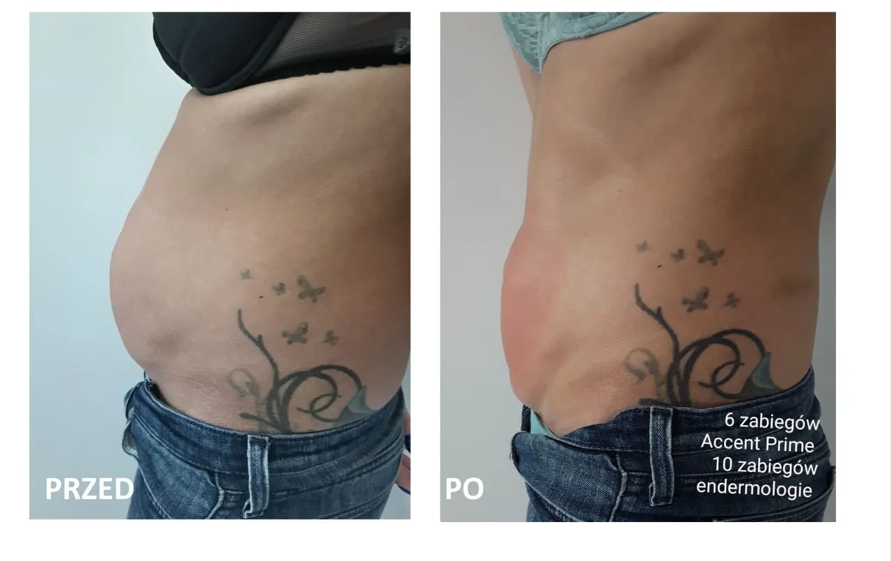 Liposukcja kawitacyjna jak działa