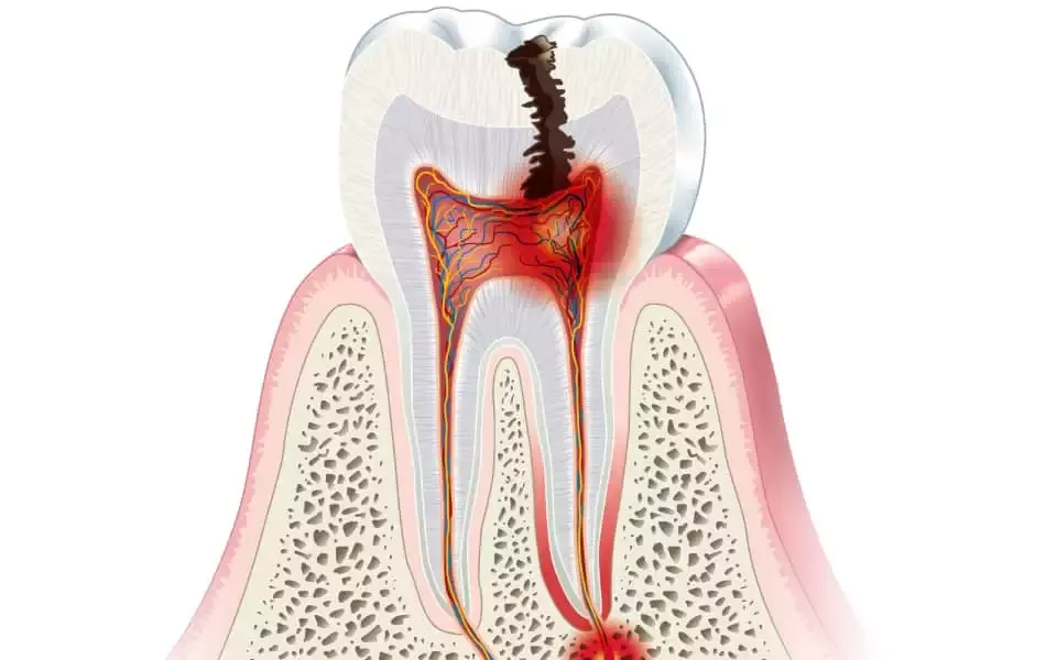 skomplikowana ekstrakcja zęba &oacute;semki, ropień zęba, pacjent z chorobami serca u dentysty