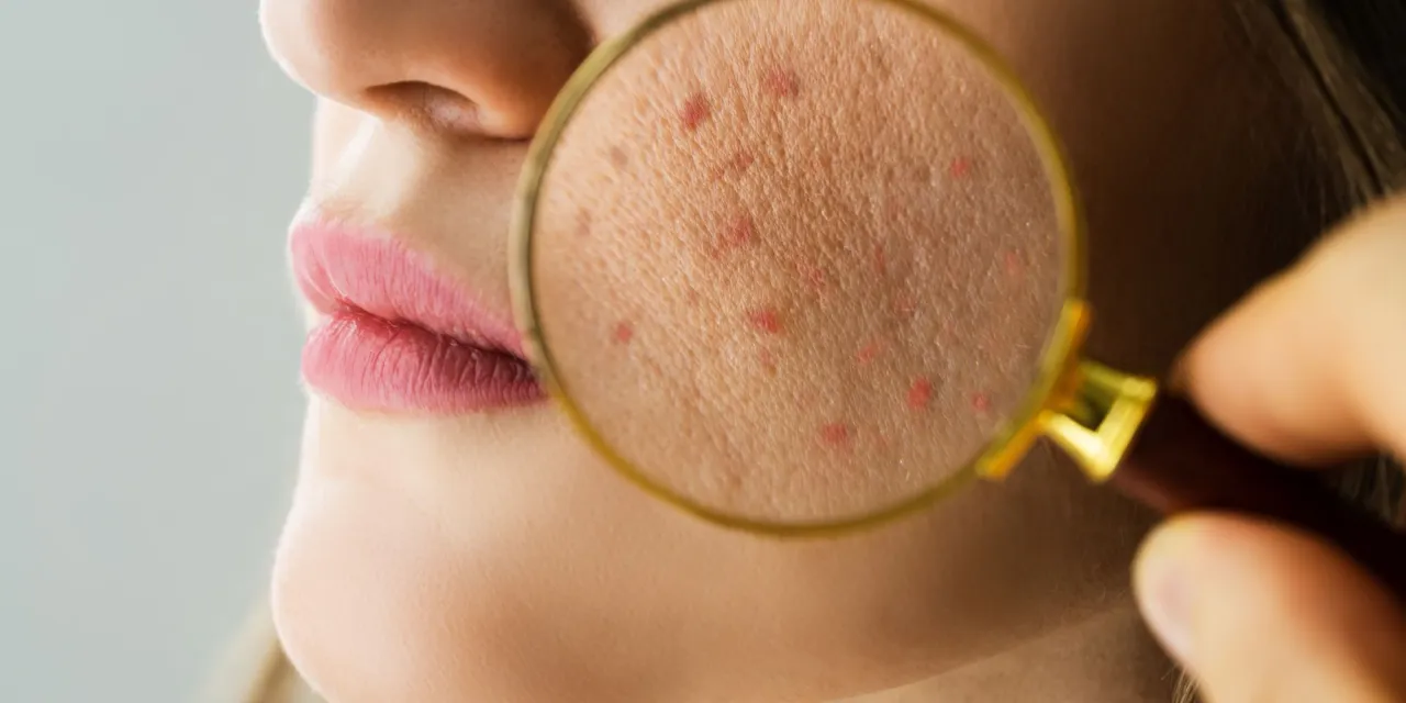 Pryszcze na twarzy - przyczyny
