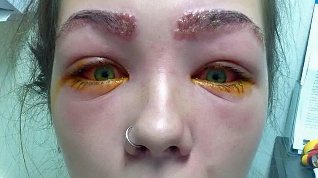 reakcja alergiczna na hennę brwi PPD vs bezpieczna henna