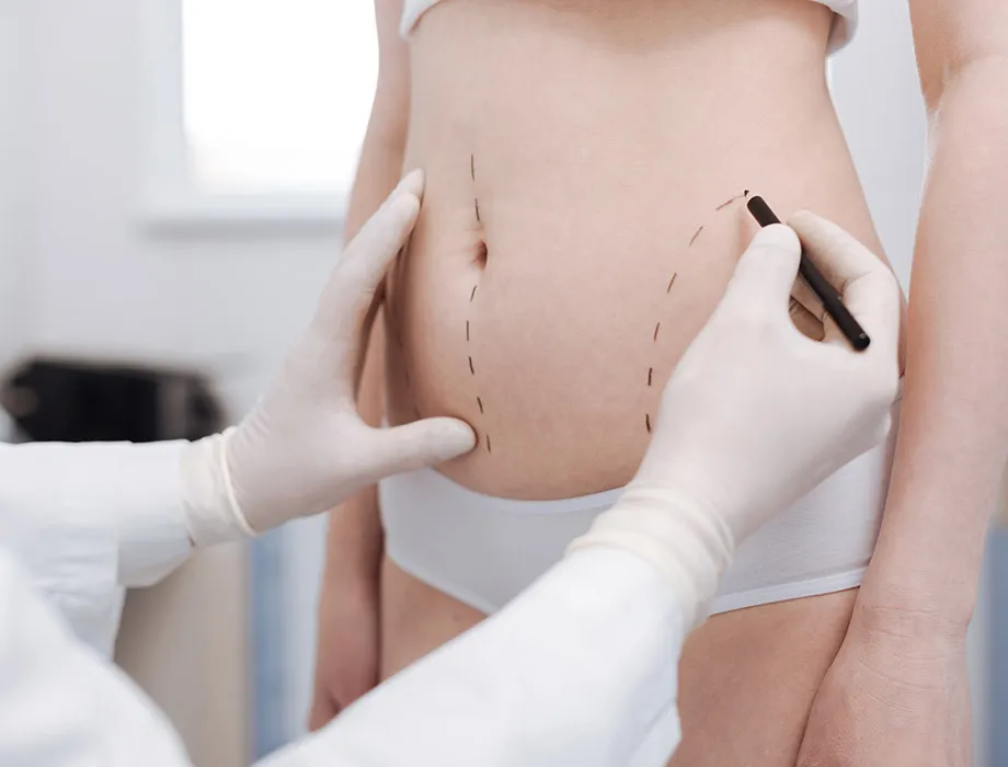 nowoczesne metody liposukcji porównanie