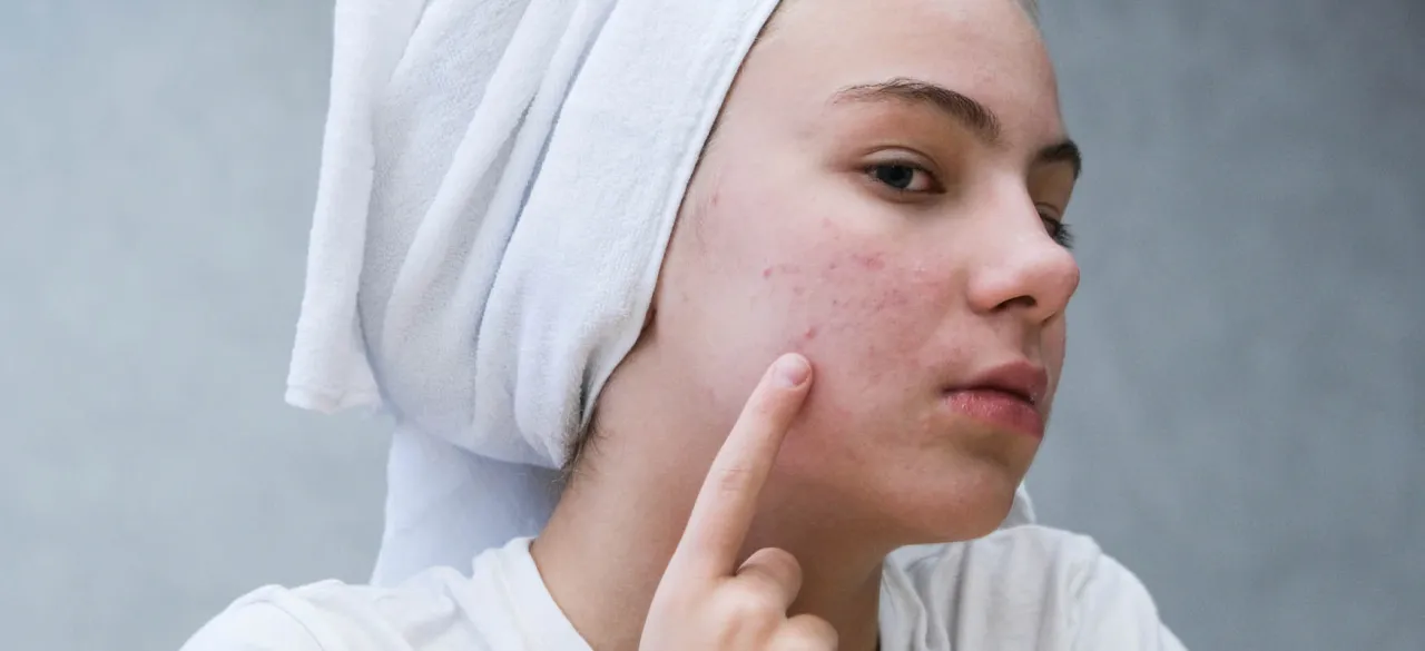 ciepły okład na pryszcza podskórnego