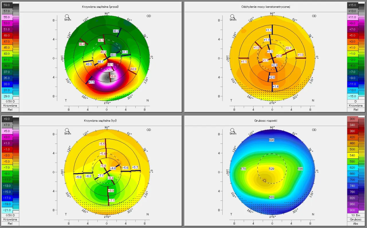 stożek rogówki porównanie zdrowa rogówka
