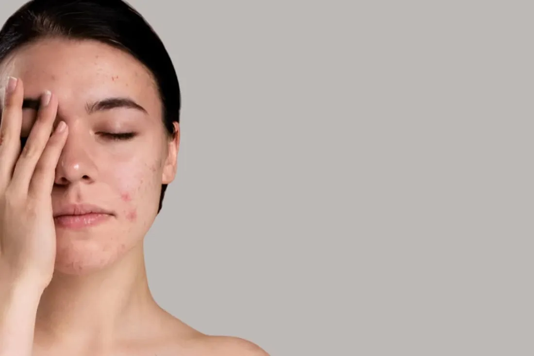 rutyna pielęgnacyjna cera trądzikowa krok po kroku
