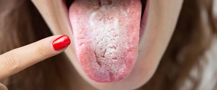 biały nalot grzybica jamy ustnej