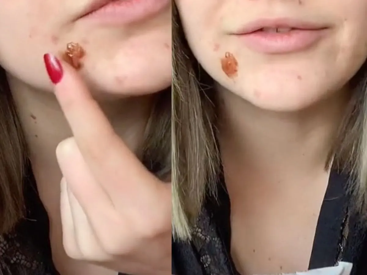 Punktowa aplikacja maści na pryszcz