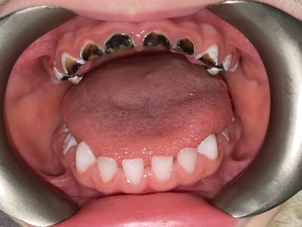 Pr&oacute;chnica zęb&oacute;w mlecznych u dzieci zdjęcia