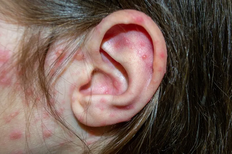 rodzaje zmian skórnych w uchu