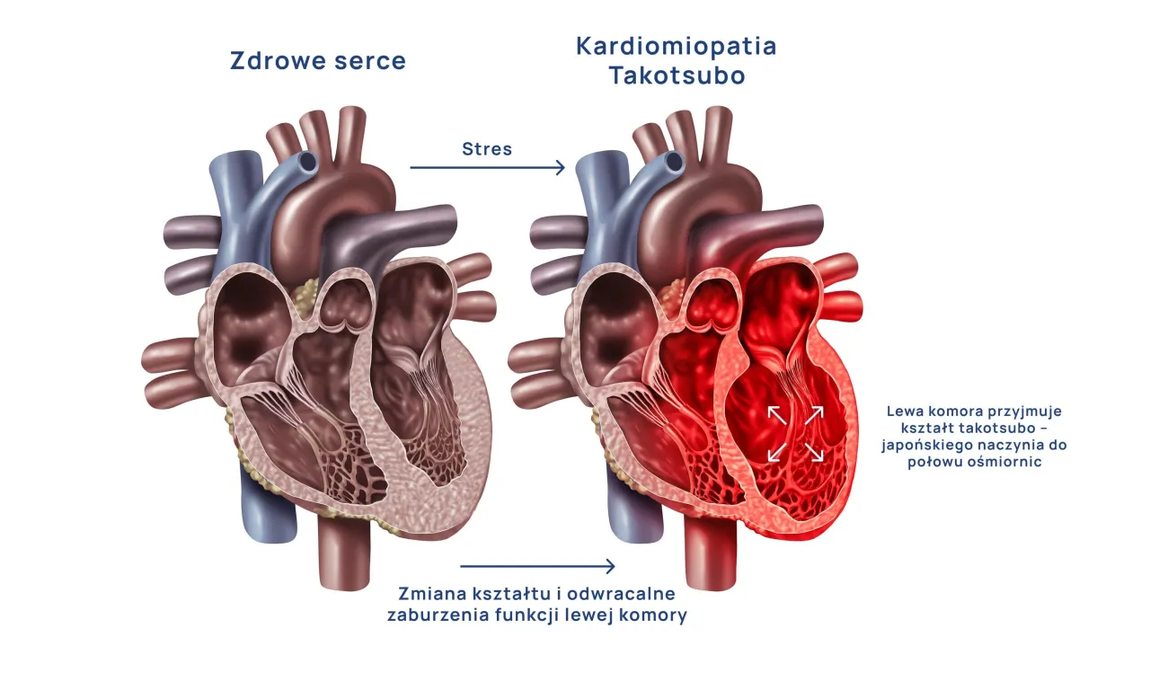 Syndrom złamanego serca definicja medyczna