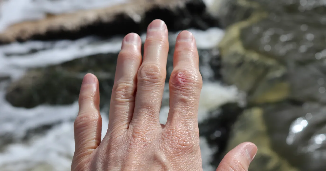 Spuchnięty palec niedokrwienie objawy