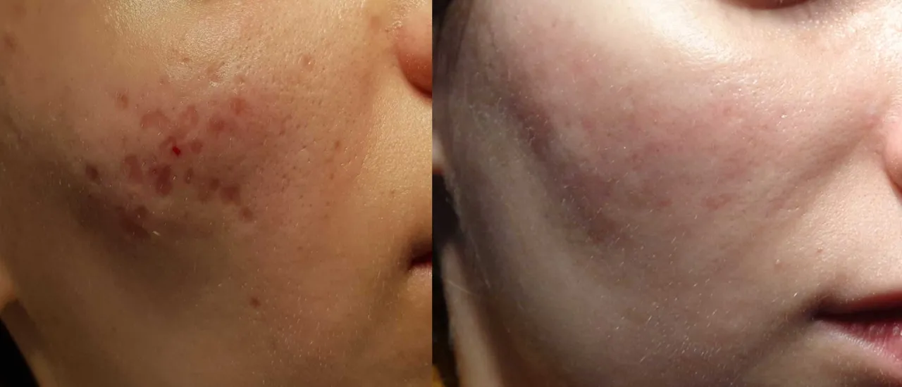 Konsultacja dermatologiczna leczenie trądziku