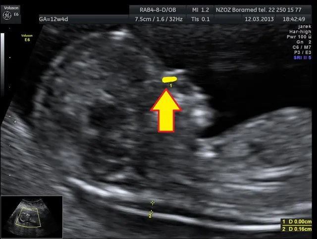 USG genetyczne płodu