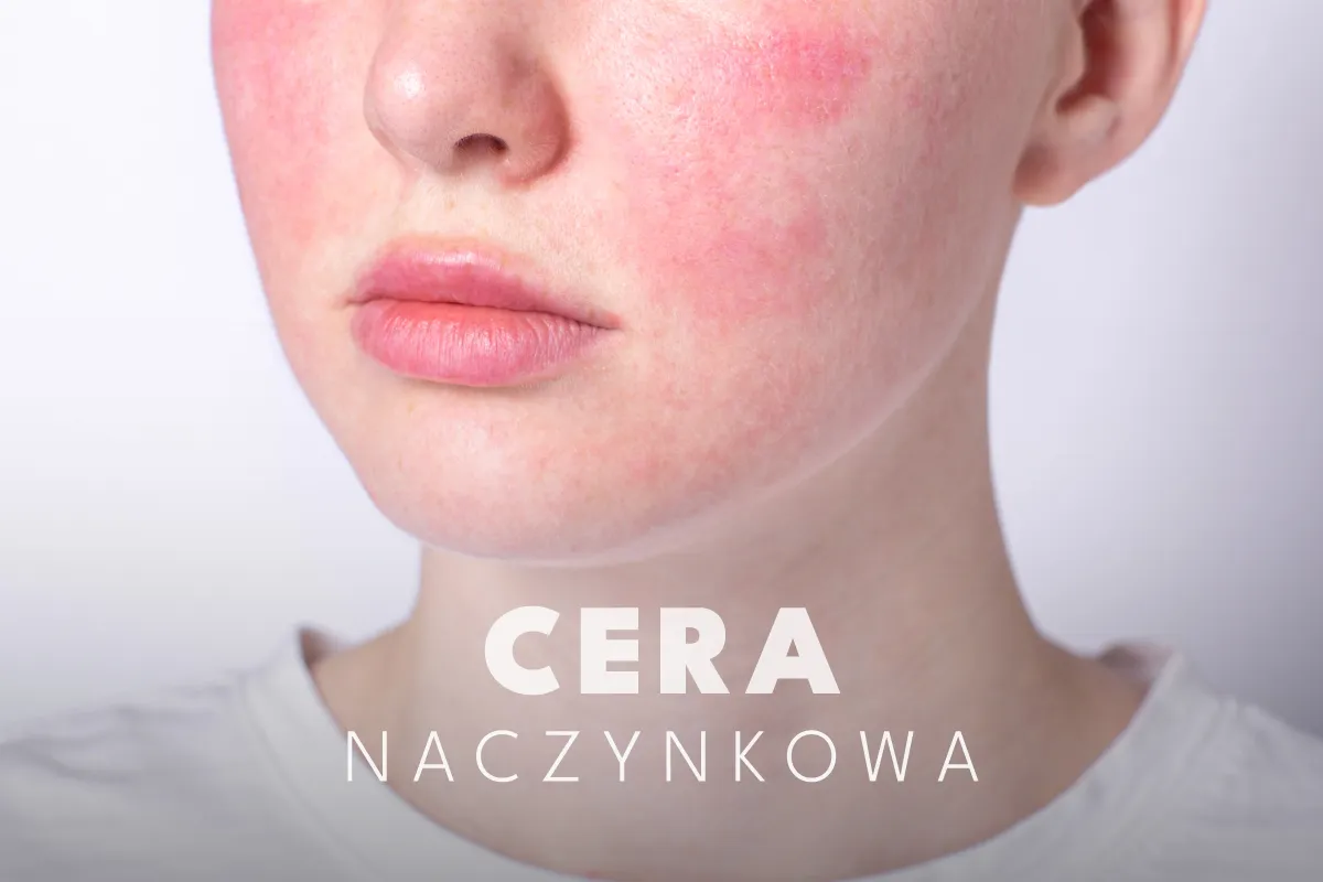 Składniki kosmetyków szkodliwe dla cery naczynkowej