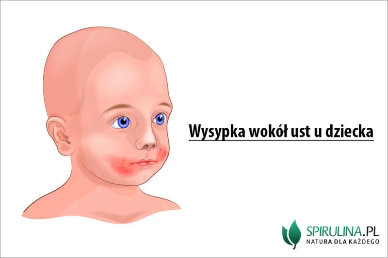 Zdjęcie Krostki wokół ust u dziecka: skuteczne sposoby na łagodzenie podrażnień