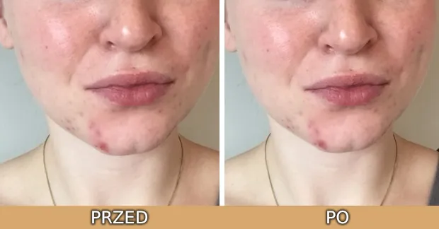 Zdjęcie Peeling z retinolem: opinie, efekty i skutki uboczne zabiegu