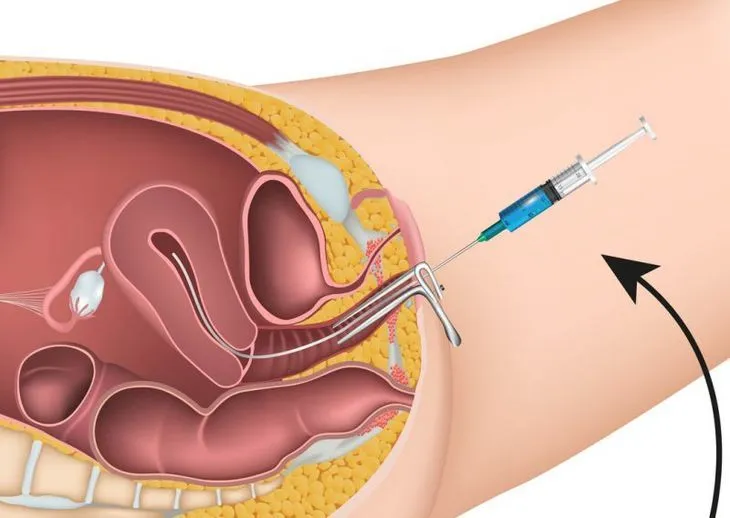 Zdjęcie Kiedy inseminacja ma sens? Zobacz najważniejsze wskazania do zabiegu