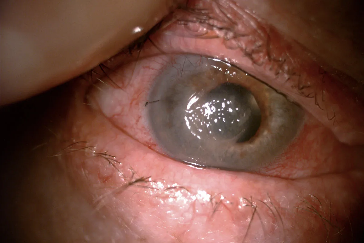 Zdjęcie Czy od cukrzycy można stracić wzrok? Poznaj ryzyko i objawy