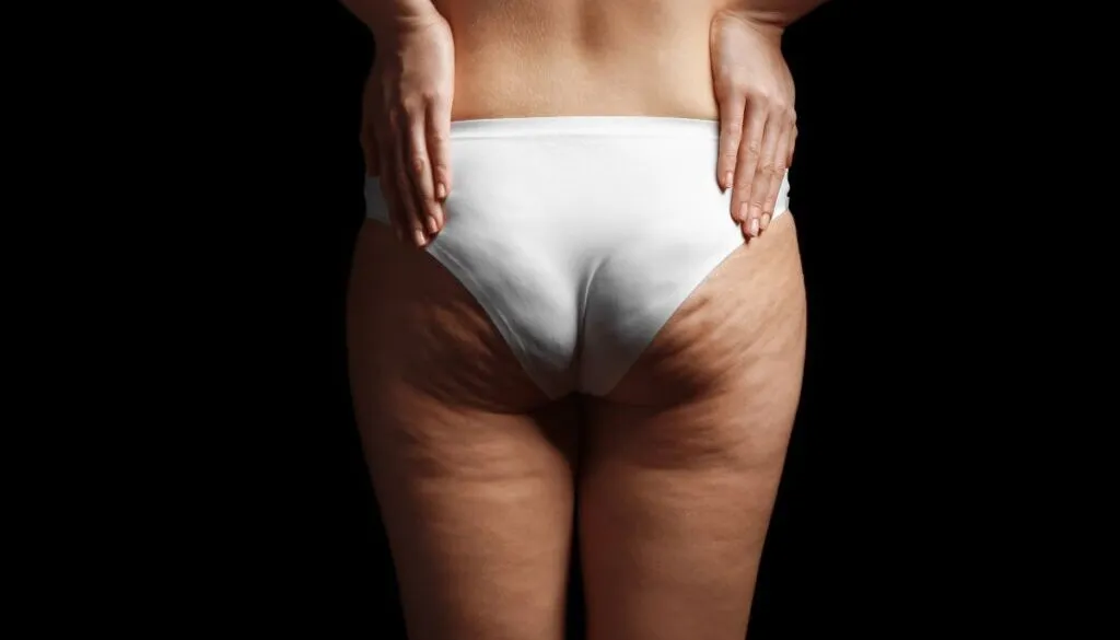 Zdjęcie Jak wygląda cellulit? Zaskakujące fakty o jego wyglądzie i przyczynach