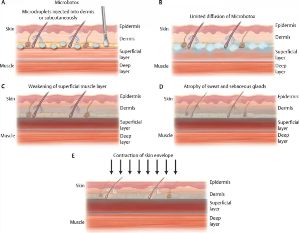 Jak działa botoks mechanizm