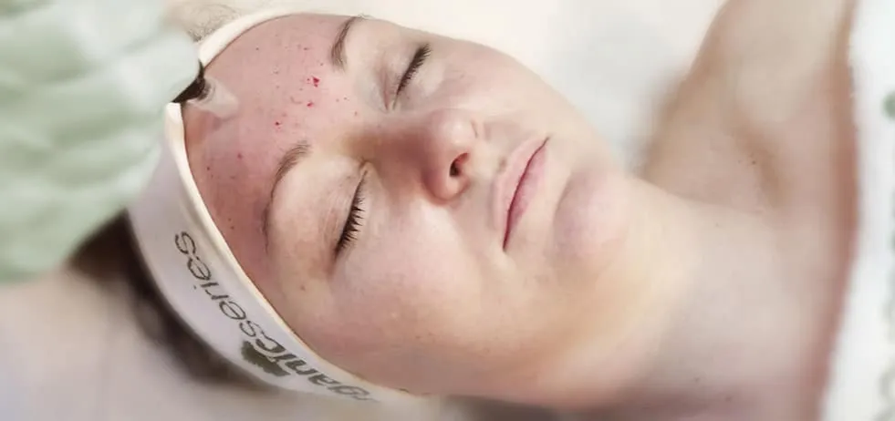 Sk&oacute;ra po zabiegu mikronakłuwania i wpływ alkoholu