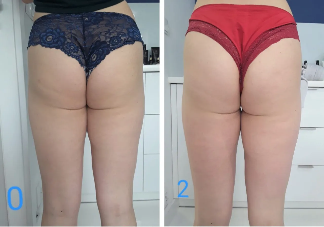 endermologia efekty cellulit przed po