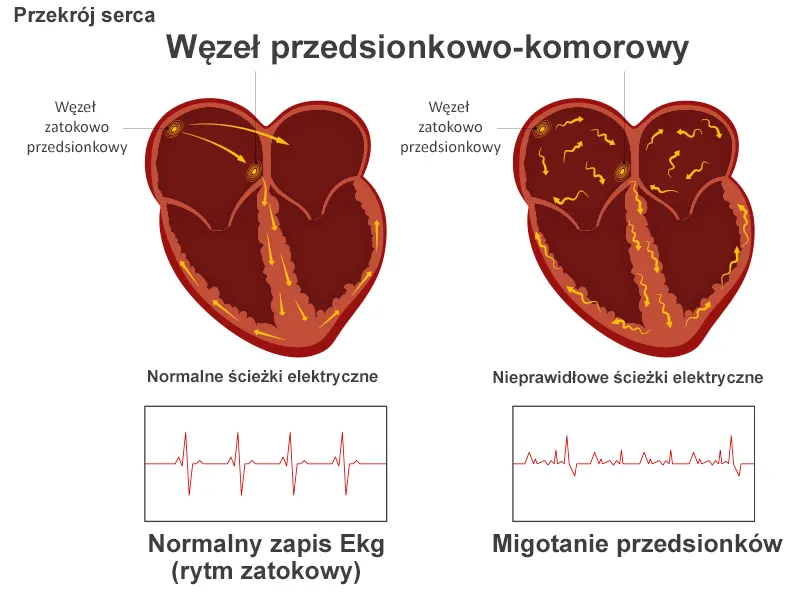 Serce migotanie przedsionk&oacute;w schemat