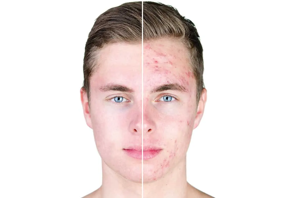 rosazea gesicht symptome oder periorale dermatitis symptome