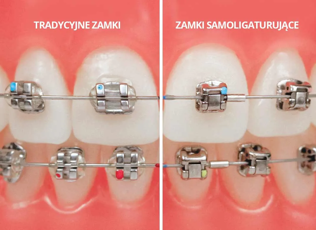 aparat na zęby czas leczenia