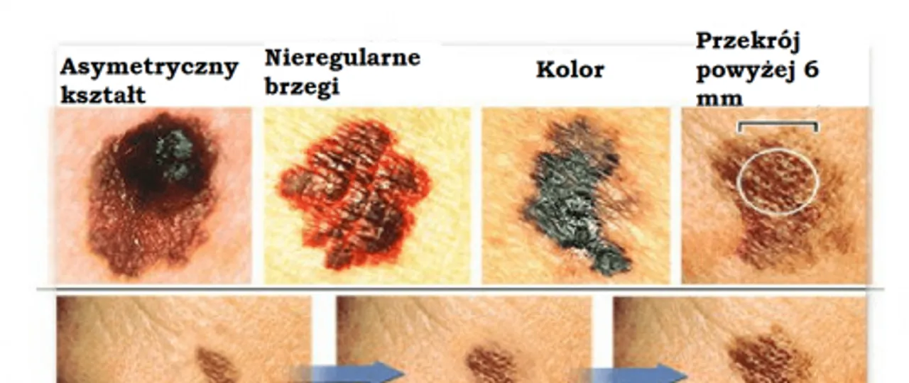 Grafika zasada ABCDE czerniak