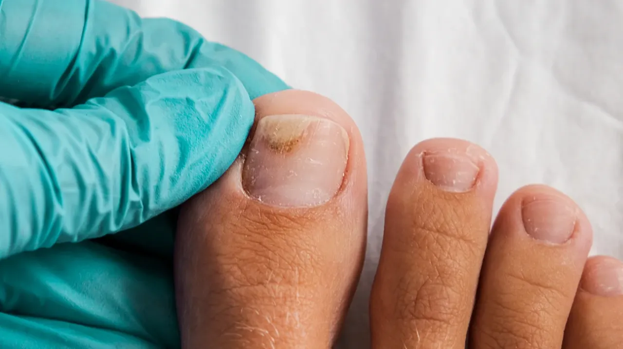 onycholiza paznokcia hybryda