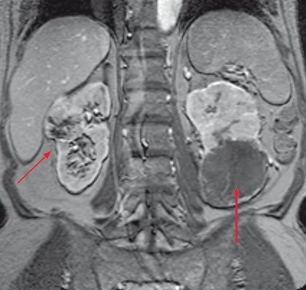 Obrazowanie nerek TK MRI urografia