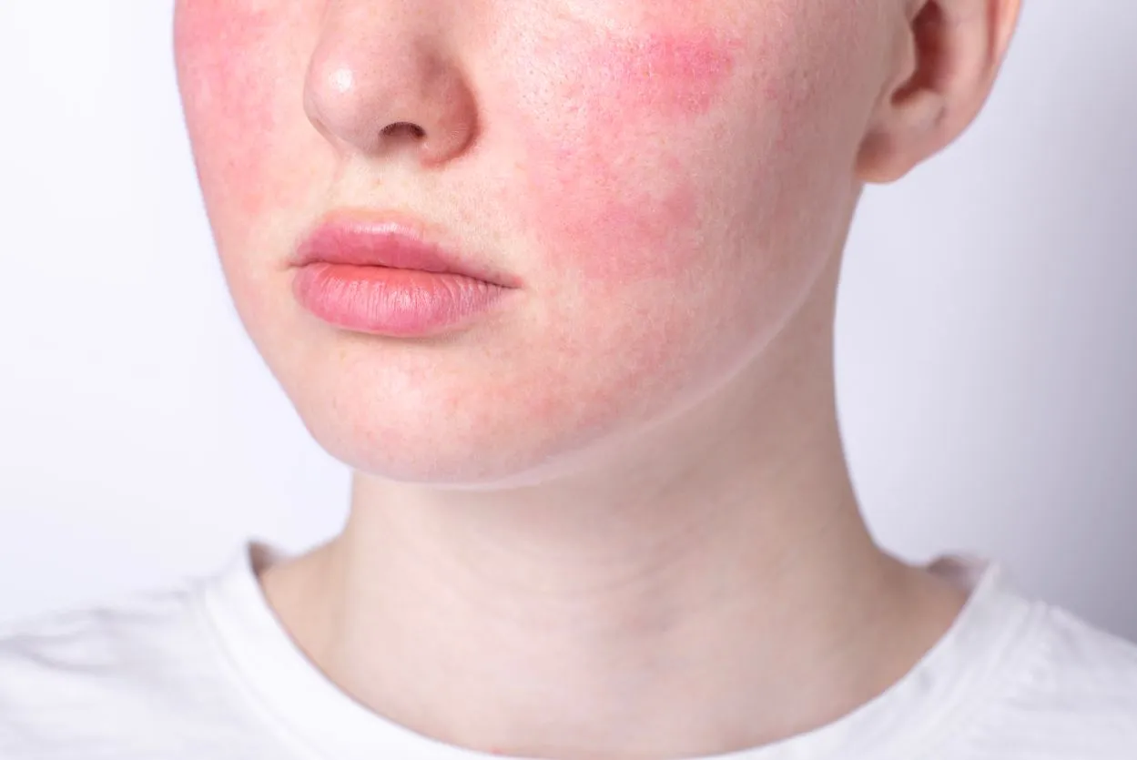 kobieta dotykająca podrażnionej sk&oacute;ry twarzy