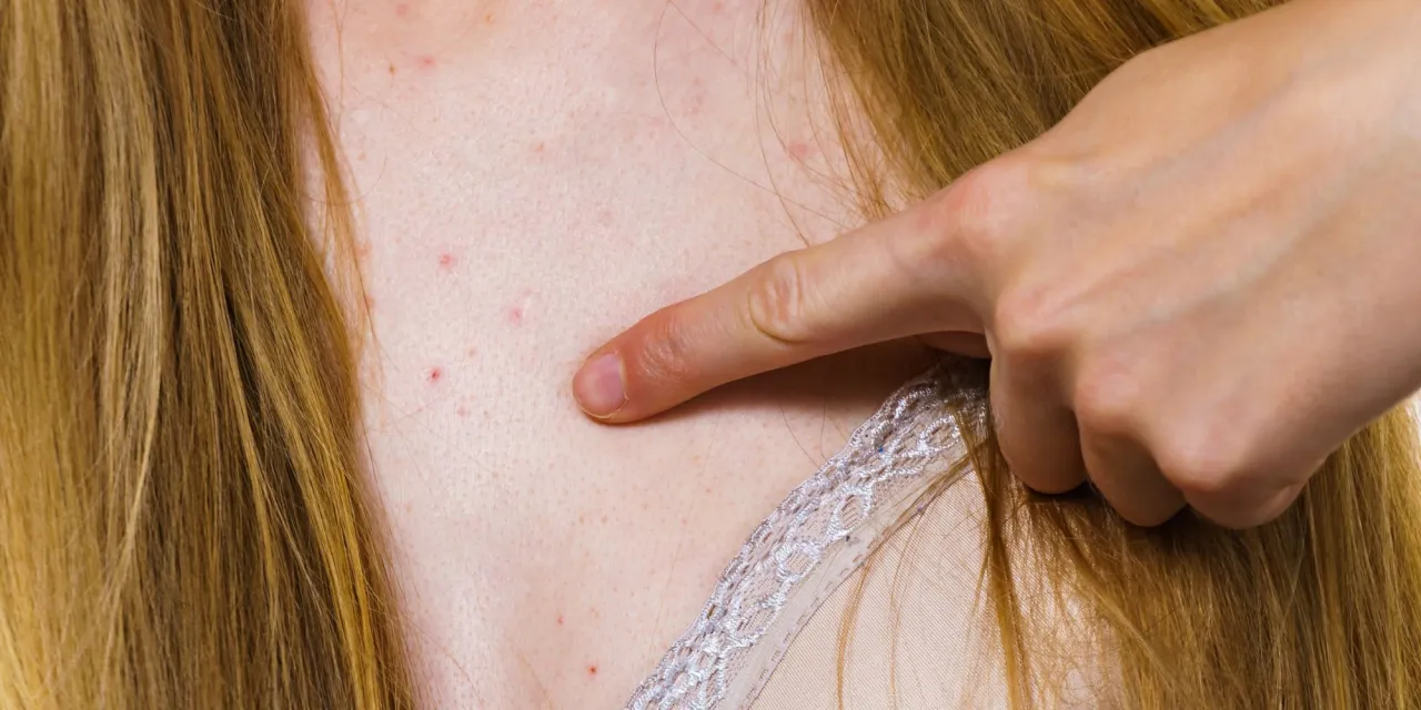 Dłoń wskazuje na pryszcze na dekolcie. Szukasz sposobu, jak pozbyć się pryszczy na dekolcie?