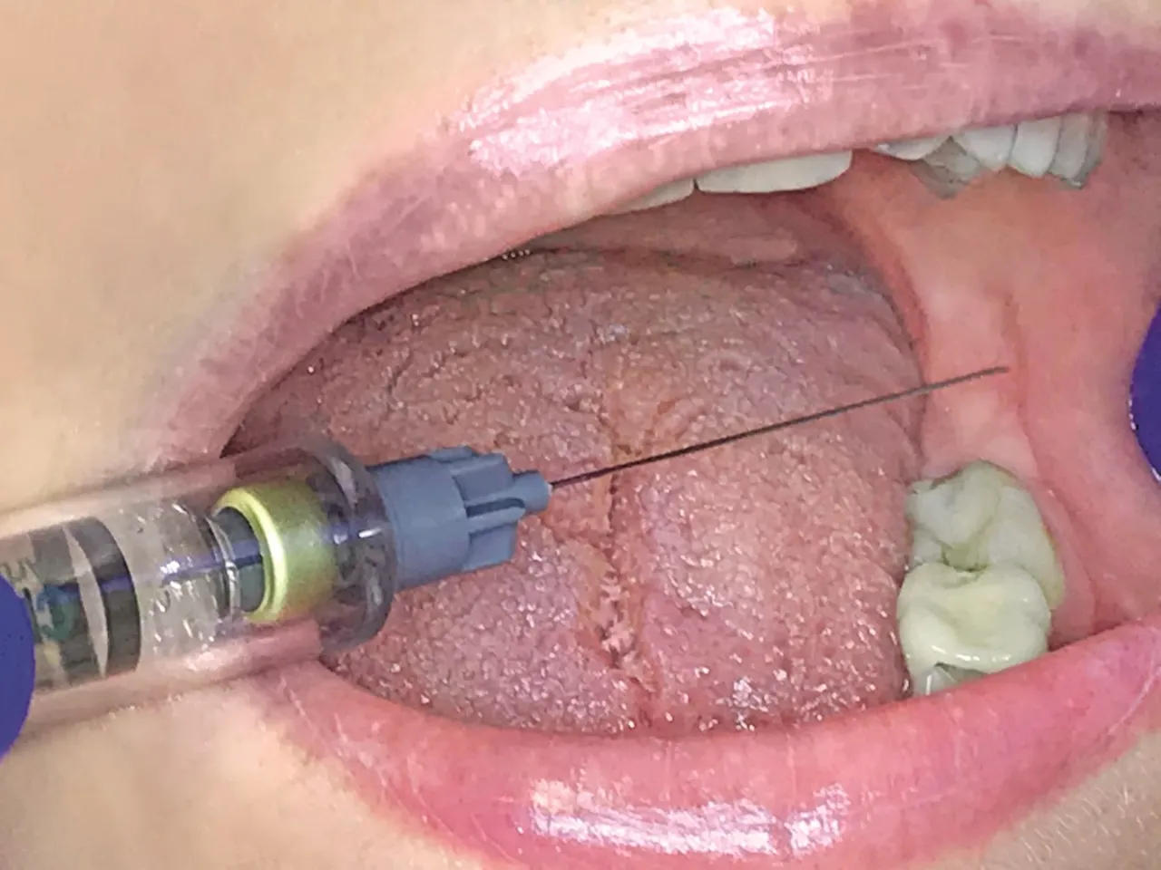 znieczulenie nasiękowe a przewodowe stomatologia