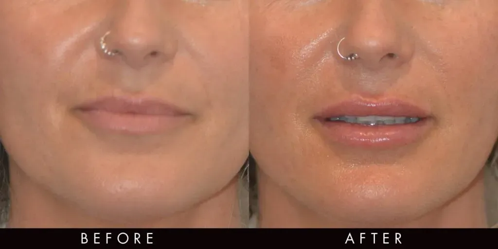 1 ml kwasu hialuronowego wizualizacja objętości, przed i po usta, bruzdy