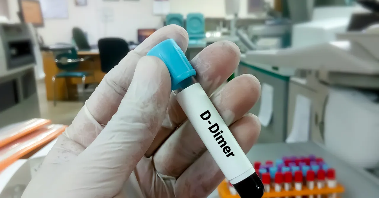 D-dimery zakrzepica zatorowość płucna schemat