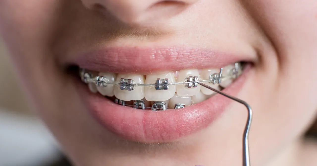 kiedy iść do ortodonty objawy wady zgryzu
